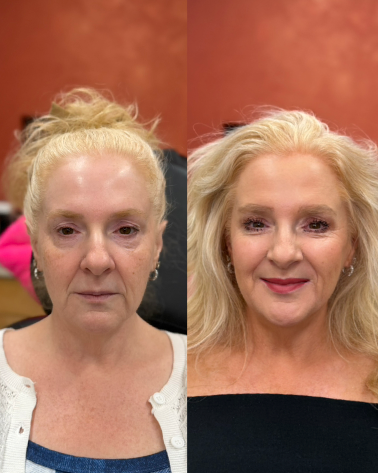 Med Spa before-and-after comparison 1