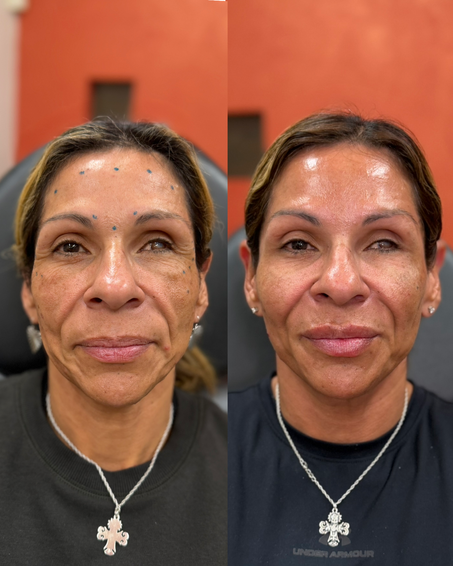 Med Spa before-and-after comparison 2