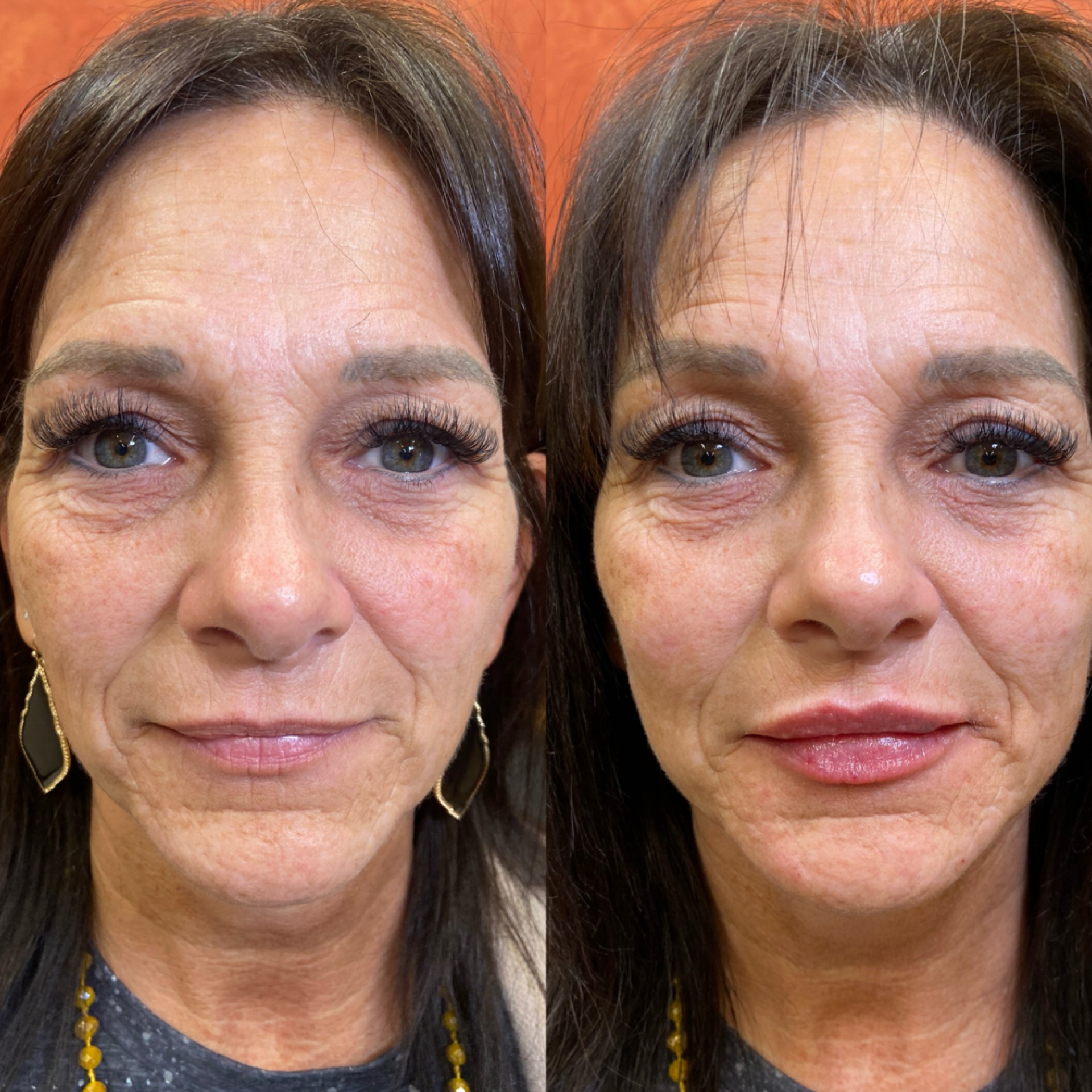 Med Spa before-and-after comparison 3