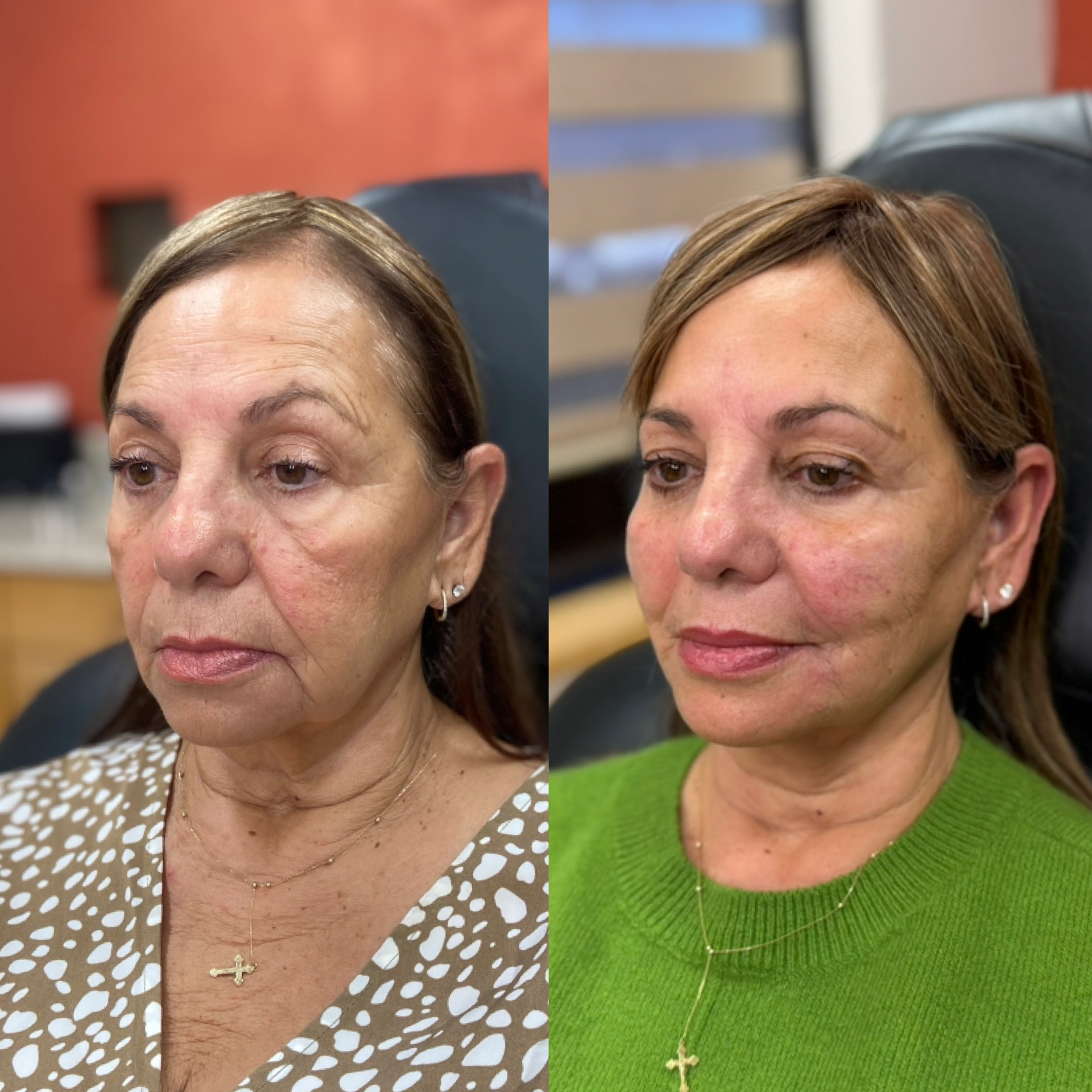 Med Spa before-and-after comparison 4