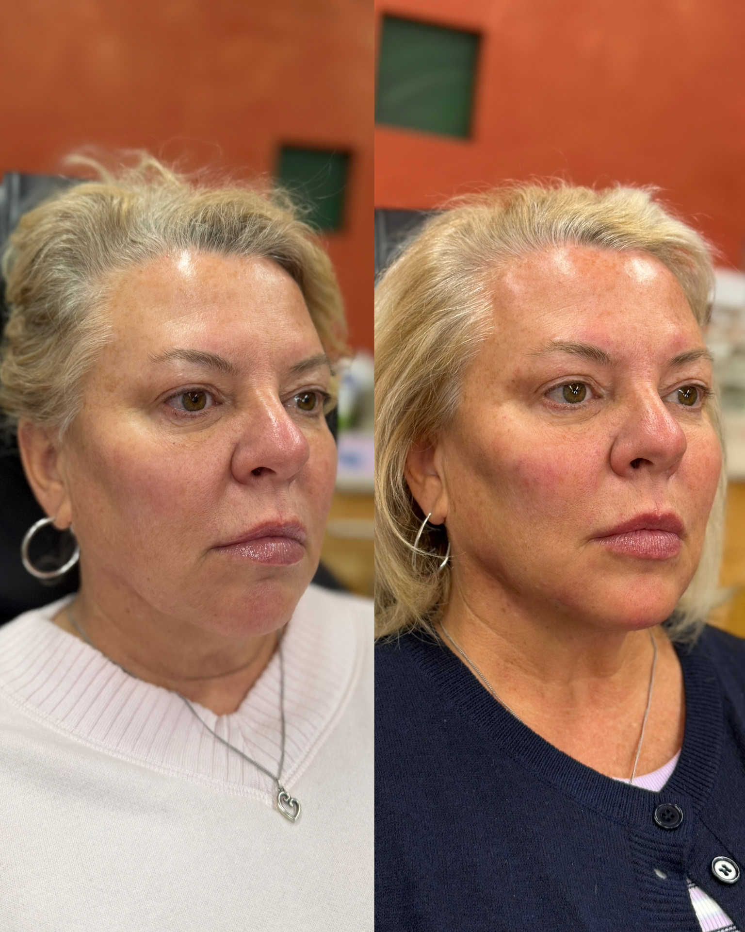 Med Spa before-and-after comparison 5