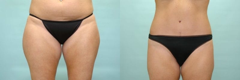 https://www.accentonyou.com/wp-content/uploads/2018/07/liposuction-b.jpg