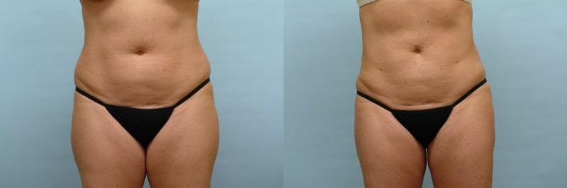 https://www.accentonyou.com/wp-content/uploads/2018/07/liposuction-g.jpg