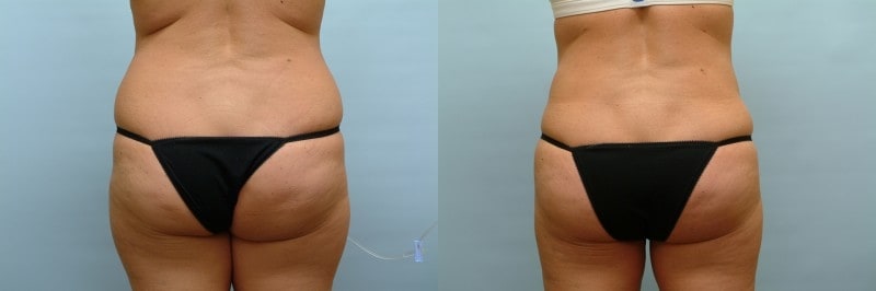 https://www.accentonyou.com/wp-content/uploads/2018/07/liposuction-h.jpg