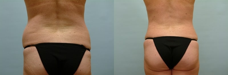 https://www.accentonyou.com/wp-content/uploads/2018/07/liposuction-i.jpg