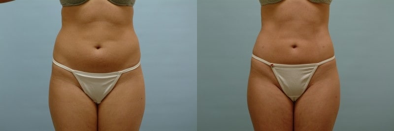 https://www.accentonyou.com/wp-content/uploads/2018/07/liposuction-k.jpg
