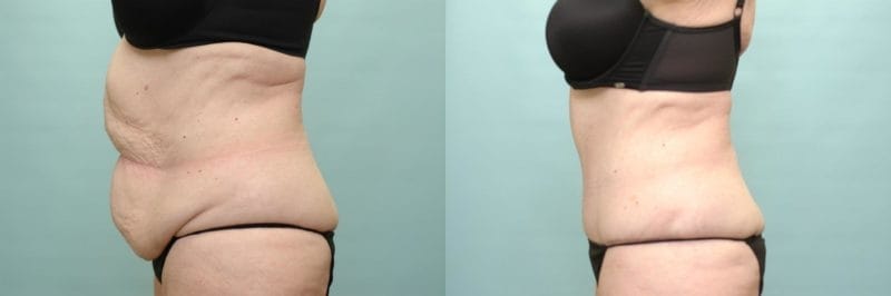 https://www.accentonyou.com/wp-content/uploads/2018/07/tummy-tuck-d.jpg