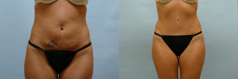 https://www.accentonyou.com/wp-content/uploads/2018/07/tummy-tuck-e.jpg