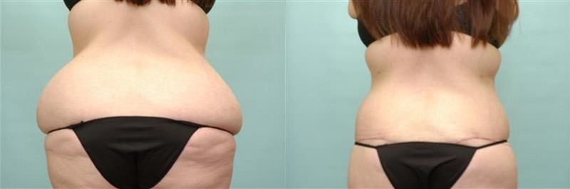 Patient Waist Tuck Before and Afters Waist Tuck Before After Arlington -  Fort Worth TX - Accent On You