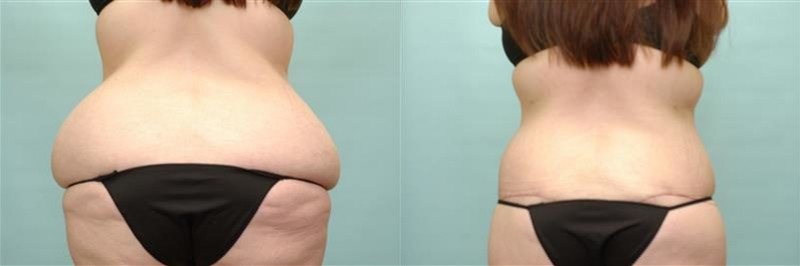 Patient Waist Tuck Before and Afters Waist Tuck Before After