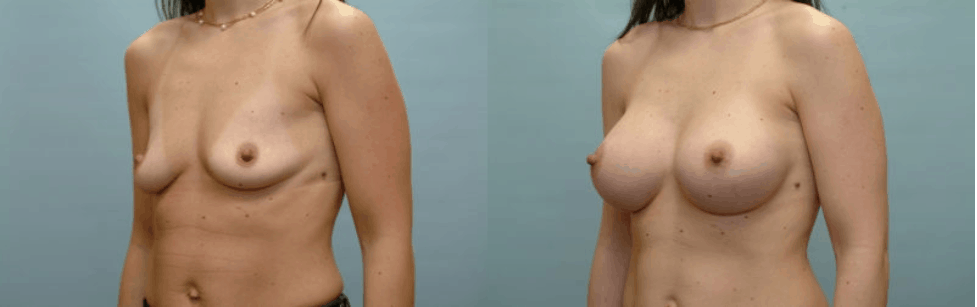 breast augmentation mansfield tx