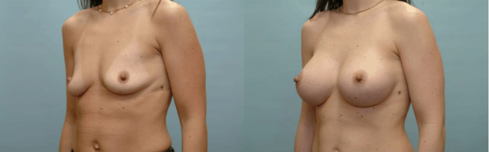https://www.accentonyou.com/wp-content/uploads/2019/11/breast-augmentation-results-grand-prairie-tx.png