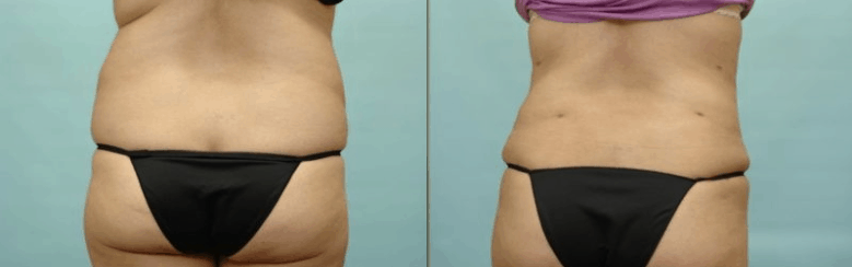 liposuction euless tx