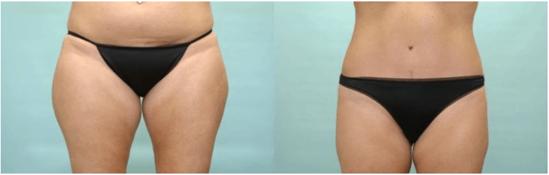 liposuction hurst tx