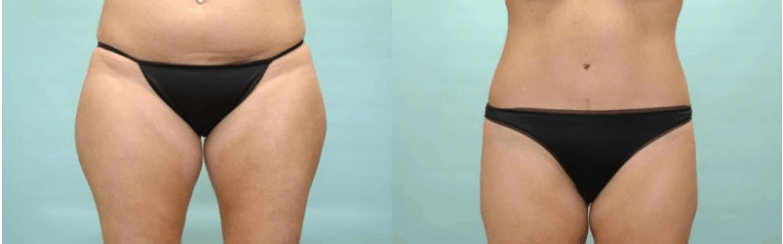 liposuction