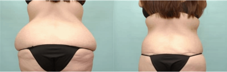 https://www.accentonyou.com/wp-content/uploads/2020/01/plastic-surgery-bedford-texas-before-after-results-1.png