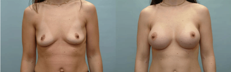 https://www.accentonyou.com/wp-content/uploads/2020/02/breast-augmentation-fort-worth-before-after-accent-on-you.png