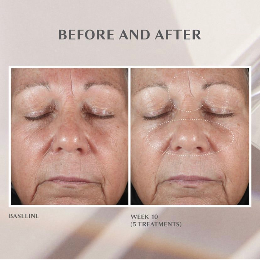 middle aged woman before and after a diamondglow facial