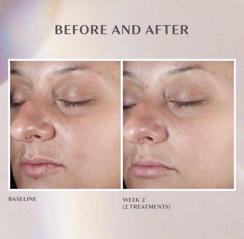 middle aged woman before and after a diamondglow facial