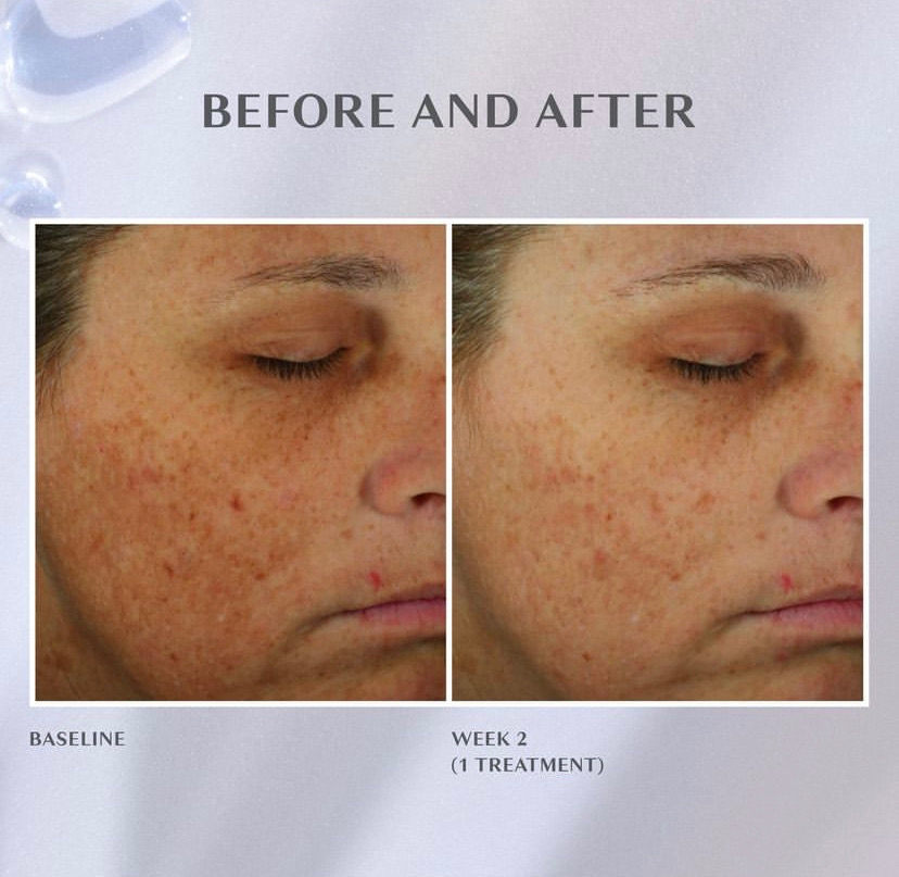 middle aged woman before and after a diamondglow facial
