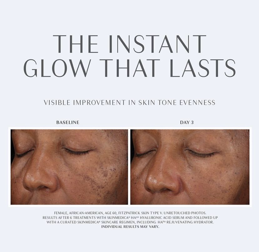 middle aged woman before and after a diamondglow facial